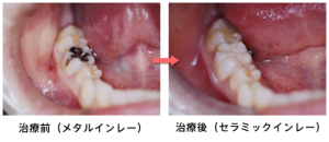セラミックを使用した詰め物（インレー）