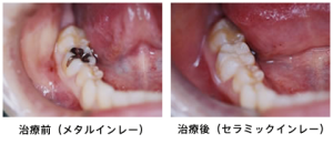 セラミックを使用した詰め物