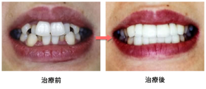 セラミックを使用した被せ物（クラウン）